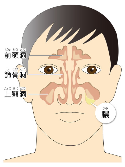 鼻づまりと頭痛が続く副鼻腔炎 東大阪のながた耳鼻咽喉科クリニック