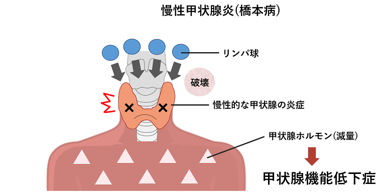 橋本病