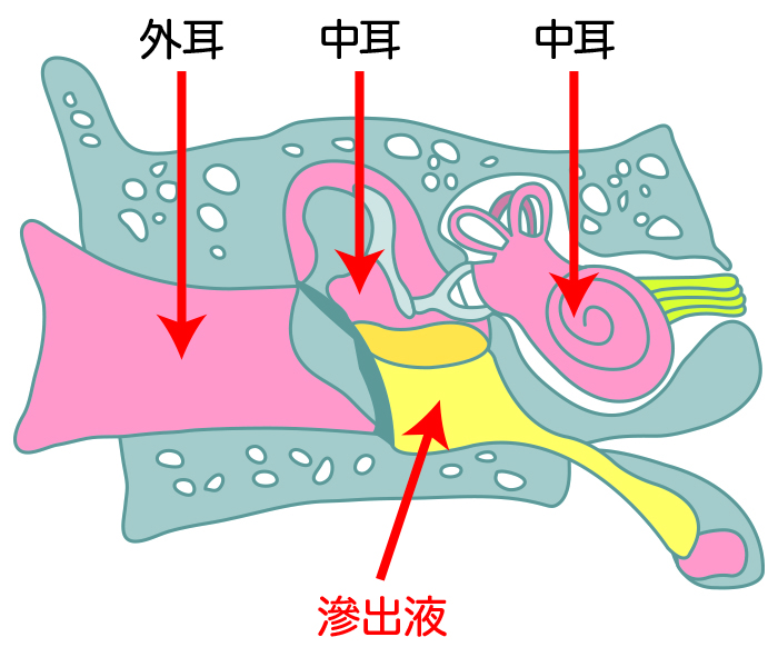 滲出性中耳炎