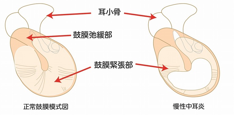 慢性中耳炎