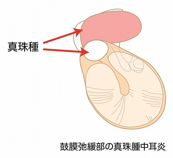 真珠種性中耳炎